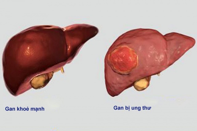 Diễn viên gạo cội Hong Kong Ngô Mạnh Đạt qua đời vì ung thư gan, căn bệnh khi phát hiện thì đã muộn - 6