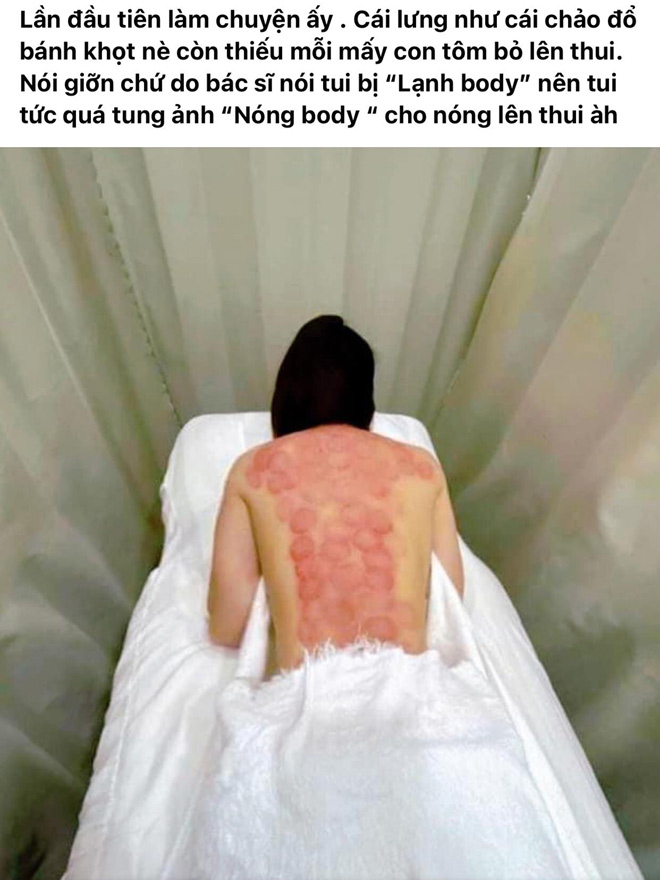 Lý Nhã Kỳ đăng ảnh sau khi dùng phương pháp giác hơi để giải cảm