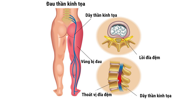 Đau thần kinh tọa là biểu hiện của thoát vị đĩa đệm thắt lưng