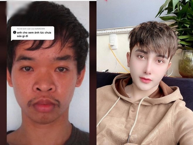 Chàng trai Việt lên báo nước ngoài vì sau phẫu thuật thẩm mỹ quá đẹp trai - 1