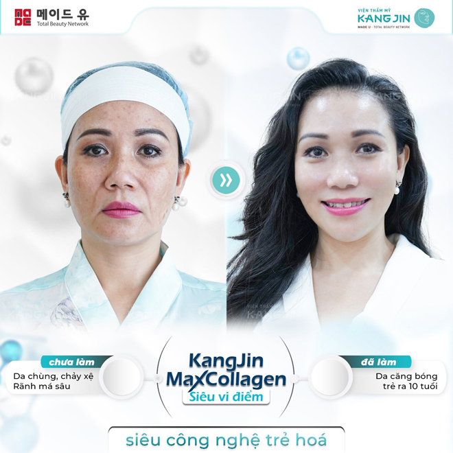 Những hình ảnh khách hàng thực hiện công nghệ KangJin Max Collagen Siêu Vi Điểm