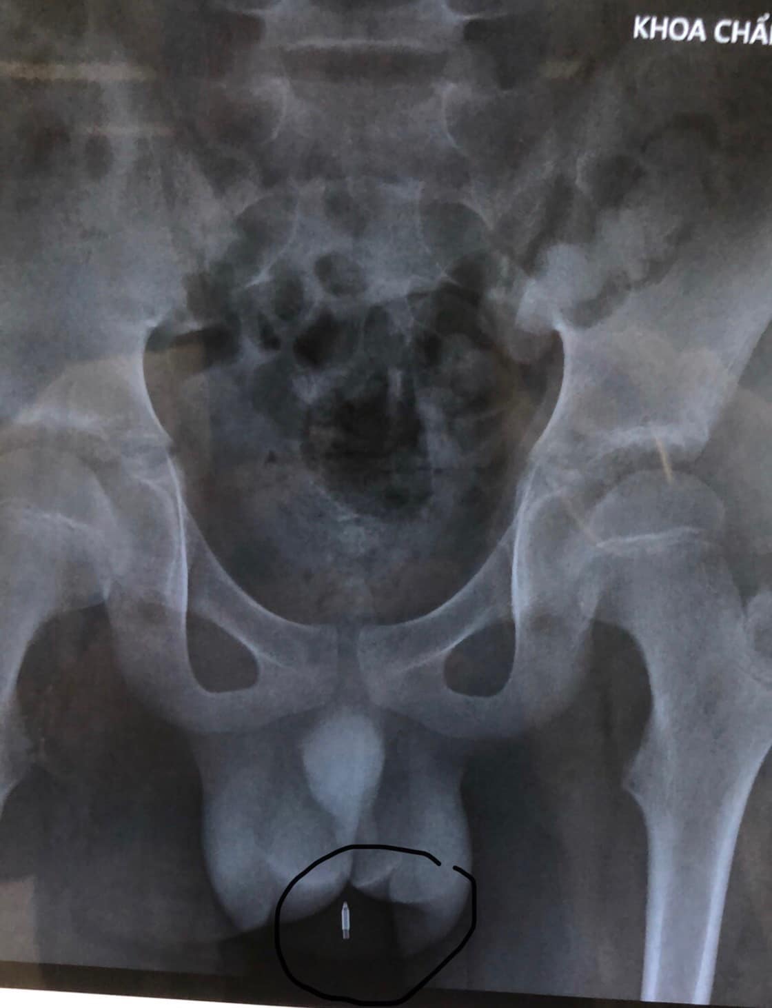 Hình ảnh phim chụp X-quang của bệnh nhi.