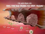 Sức khỏe đời sống - Ung thư đại trực tràng không còn là &quot;tử thần&quot; nếu ai cũng biết những điều này