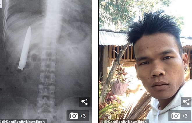 Thanh niên Philippines bị dao đâm xuyên ngực mà không hay biết.