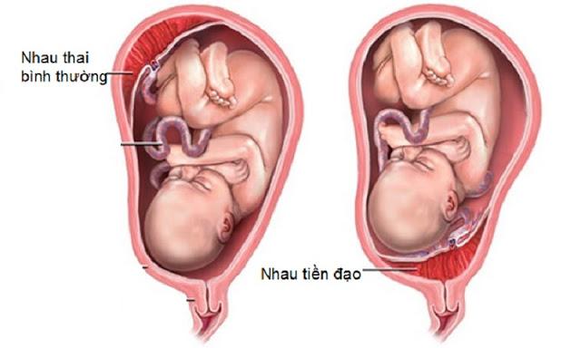 Nhau tiền đạo là một trong những vấn đề nghiêm trọng gây chảy máu sau khi quan hệ tình dục ở thai phụ.