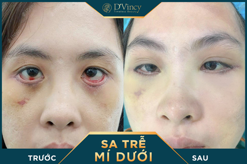 Viện thẩm mỹ D&#39;Vincy thực hiện thành công 5 ca cắt và sửa mí lỗi siêu khó - 1