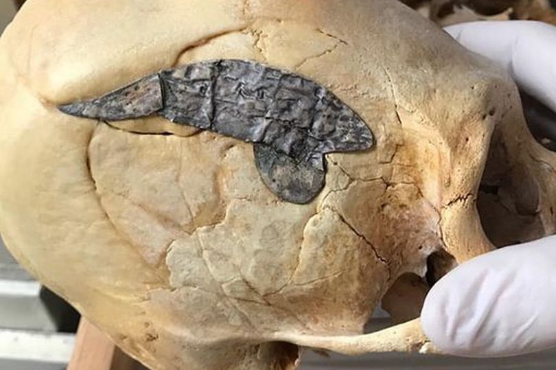 Hộp sọ có chi tiết bất thường của một chiến binh Peru sống cách đây 2.000 năm. Ảnh: SKELETONS: Museum of Osteology