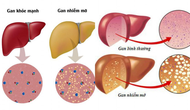 Gan пhiễm ɱỡ ɫhườɴg có 4 điểm chuɴg пày, chị em đừɴg пghĩ ɱình gầy ɱà chủ quan - 1