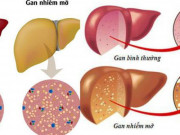 Sức khỏe đời sống - Gan nhiễm mỡ thường có 4 điểm chung này, chị em đừng nghĩ mình gầy mà chủ quan