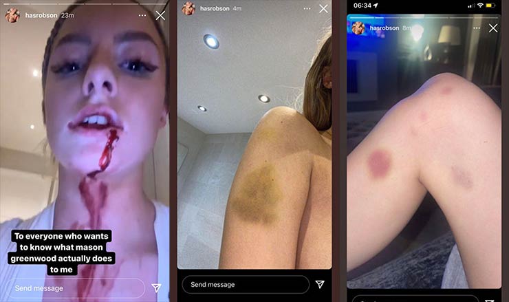 Cô Harriet Robson đăng một loạt ảnh các vết thương của mình và tố cáo Greenwood