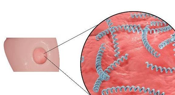 Cẩn trọng với 3 dấu hiệu âm thầm của bệnh giang mai - 1