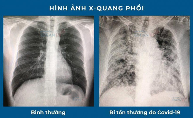 Hình ảnh xơ phổi hậu COVID -19 (Ảnh minh họa)