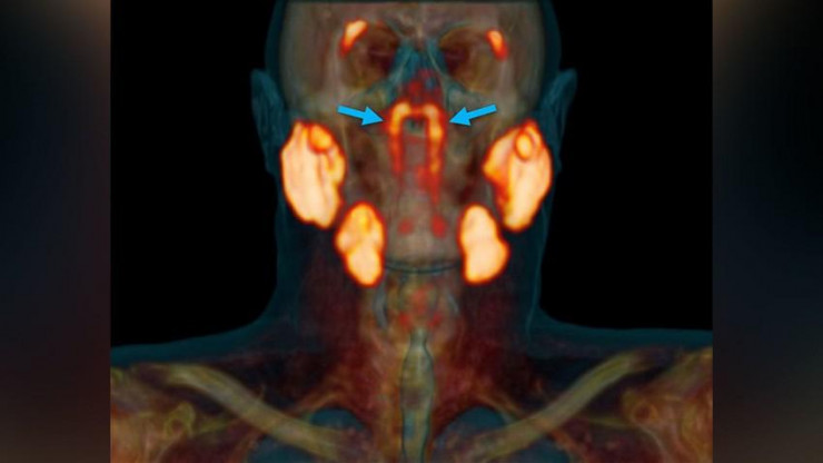Các tuyến nước bọt hoàn toàn mới ở 2 bên vòm họng của bệnh nhân trải qua xạ trị ung thư. Ảnh: CNN