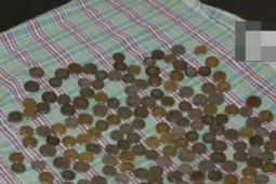 Bác sĩ sửng sốt phát hiện 187 đồng tiền xu trong bụng người đàn ông
