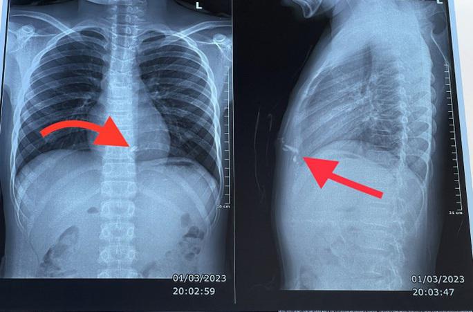 Hình ảnh dị vật kim loại trong lồng ngực nằm sau xương ức bên trái của bệnh nhân. Ảnh: Bệnh viện cung cấp