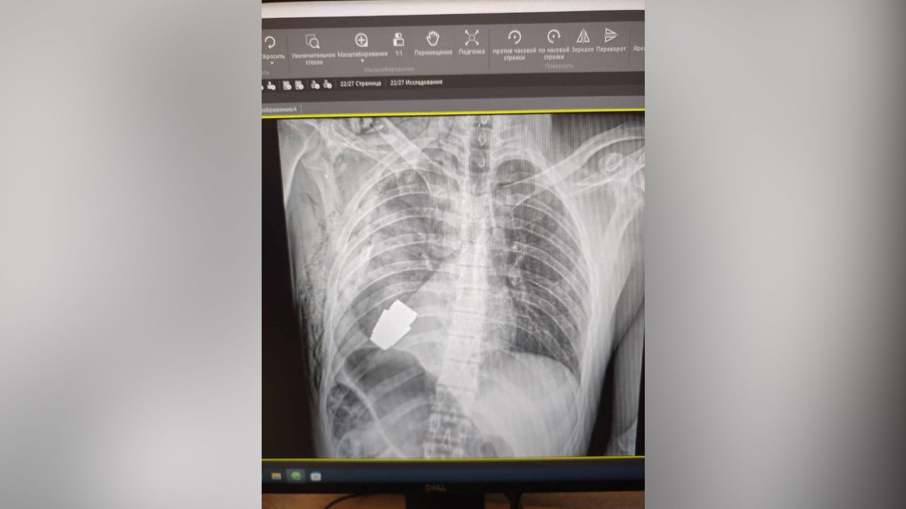 Ảnh chụp X quang cho thấy quả đạn lớn chưa nổ nằm sâu trong ngực binh sĩ Ukraine (ảnh: CNN)