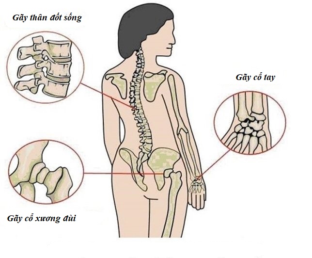 Biến chứng nguy hiểm của loãng xương là gãy xương.