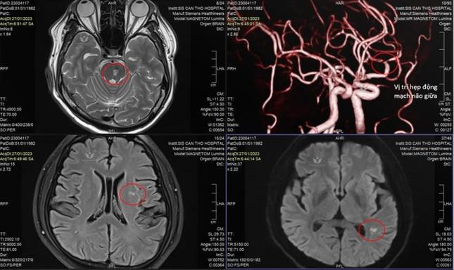 Vùng khoanh tròn trên kết quả kiểm tra hình ảnh là vị trí nhồi máu não ở bệnh nhân