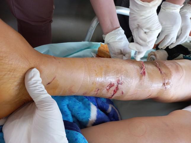 Các bác sĩ xử lý vết thương cho một trường hợp bị chó tấn công