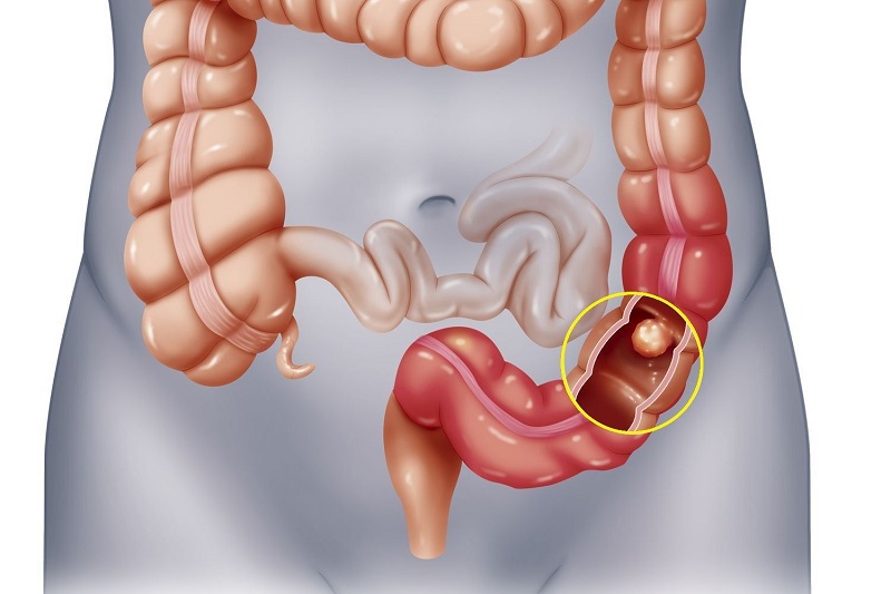 Tiktoker nổi tiếng qua đời vì ung thư ruột kết ở tuổi 35, đâu là những yếu tố nguy cơ hàng đầu của căn bệnh này? - 2