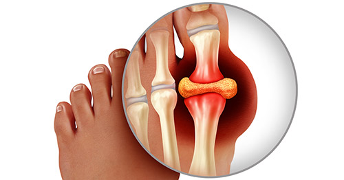 Axit uric dư thừa sẽ biến thành các tinh thể hình kim trong khớp, gây ra các đợt bùng phát bệnh gout.
