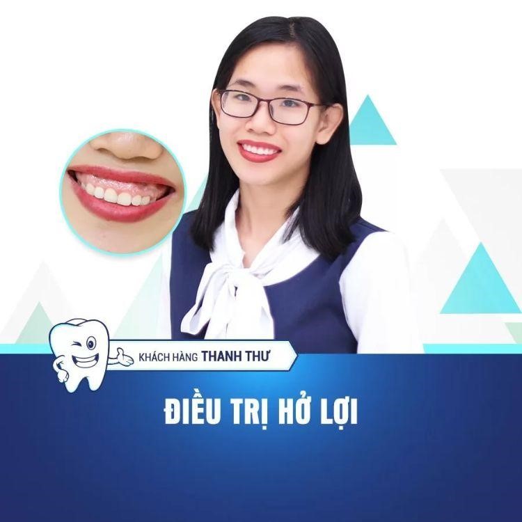 Cắt lợi thẩm mỹ nhẹ nhàng trong tích tắc, có thật không? - 4