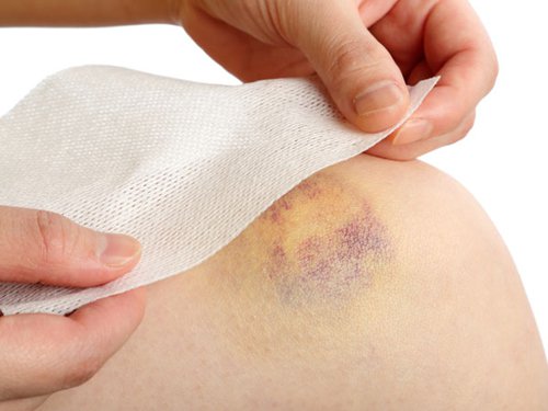 Xuất hiện vết bầm tím trên da, rất có thể bạn đang mắc bệnh này, đây là dấu hiệu cần được khám sớm - 2