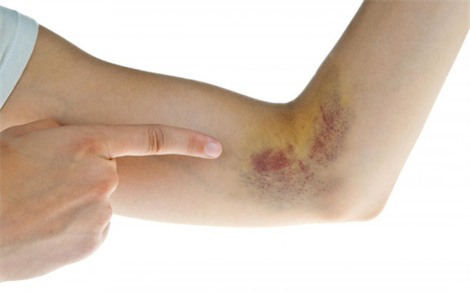 Xuất hiện vết bầm tím trên da, rất có thể bạn đang mắc bệnh này, đây là dấu hiệu cần được khám sớm - 1
