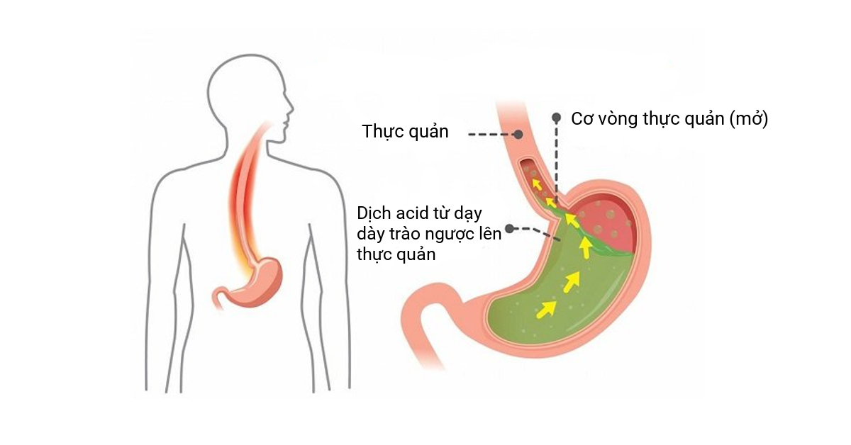 Đầy hơi, chướng bụng mãi không dứt – “Trùm cuối” trào ngược dạ dày đang cảnh báo bạn điều gì? - 3