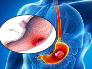 Sức khỏe đời sống - Ung thư dạ dày chẳng khác nào &quot;tử thần&quot; với nhiều người, ai cũng nên biết những điều này