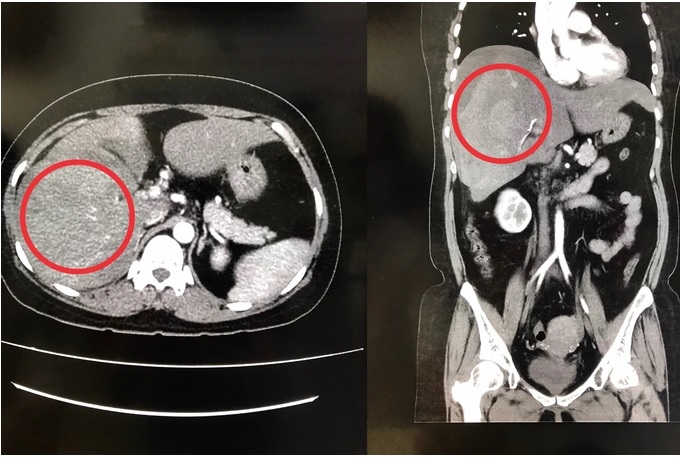 Ảnh chụp CT-scan cho thấy gan phải của chị L. bị vỡ. Ảnh: DT