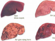 Sức khỏe đời sống - Những người nào dễ mắc ung thư gan, cần đi khám sớm?