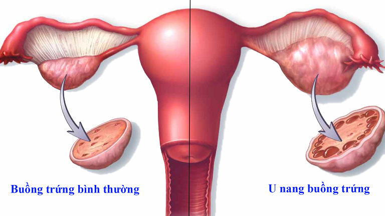 U nang buồng trứng có tỷ lệ tái phát lên tới 25% sau mổ