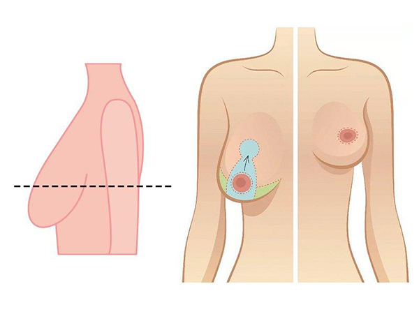 “Giải cứu” ngực sa trễ cấp độ 4 với phương pháp treo sa trễ đường quầng cùng bác sĩ Nguyễn Đắc Linh - 1