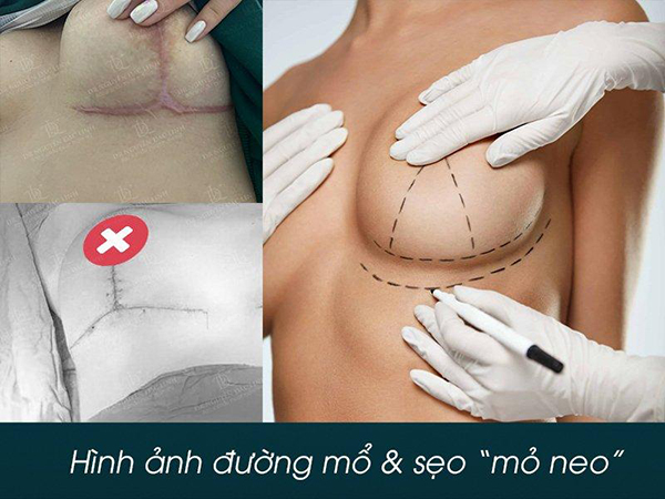 “Giải cứu” ngực sa trễ cấp độ 4 với phương pháp treo sa trễ đường quầng cùng bác sĩ Nguyễn Đắc Linh - 2