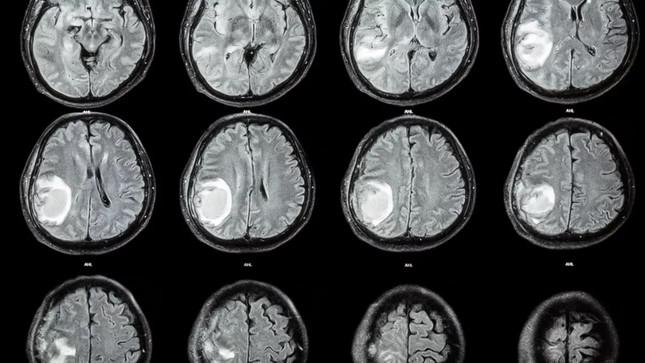 Quét CT trên nền đen cho thấy một khối màu trắng sáng trong não của đứa trẻ 1 tuổi