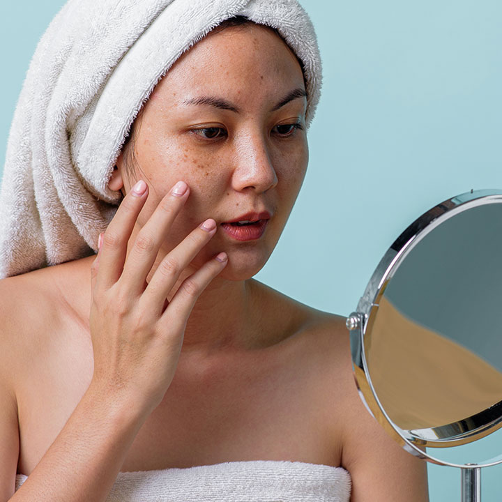 Tăng sắc tố da xảy ra khi da tạo ra quá nhiều melatonin.&nbsp;Các nguyên nhân phổ biến nhất của các đốm đen bao gồm&nbsp;tiếp xúc với tia UV&nbsp;, sẹo và lão hóa.&nbsp;Đây là một vấn đề&nbsp;khó điều trị và có thể mất thời gian cũng như sự kiên nhẫn.