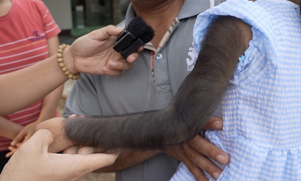Kỳ lạ bé gái có “cánh tay khỉ”, da đen sì, mọc đầy lông - 1