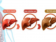 Sức khỏe đời sống - Người bị gan nhiễm mỡ không ăn 5 nhóm thực phẩm này để giảm gánh nặng cho gan!