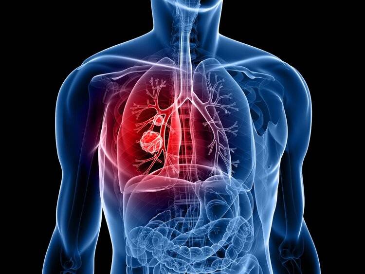 3 triệu chứng tưởng như cảm lạnh nhưng lại là ung thư phổi - 2