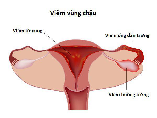 Bệnh lậu gây bệnh viêm vùng chậu ở phụ nữ.