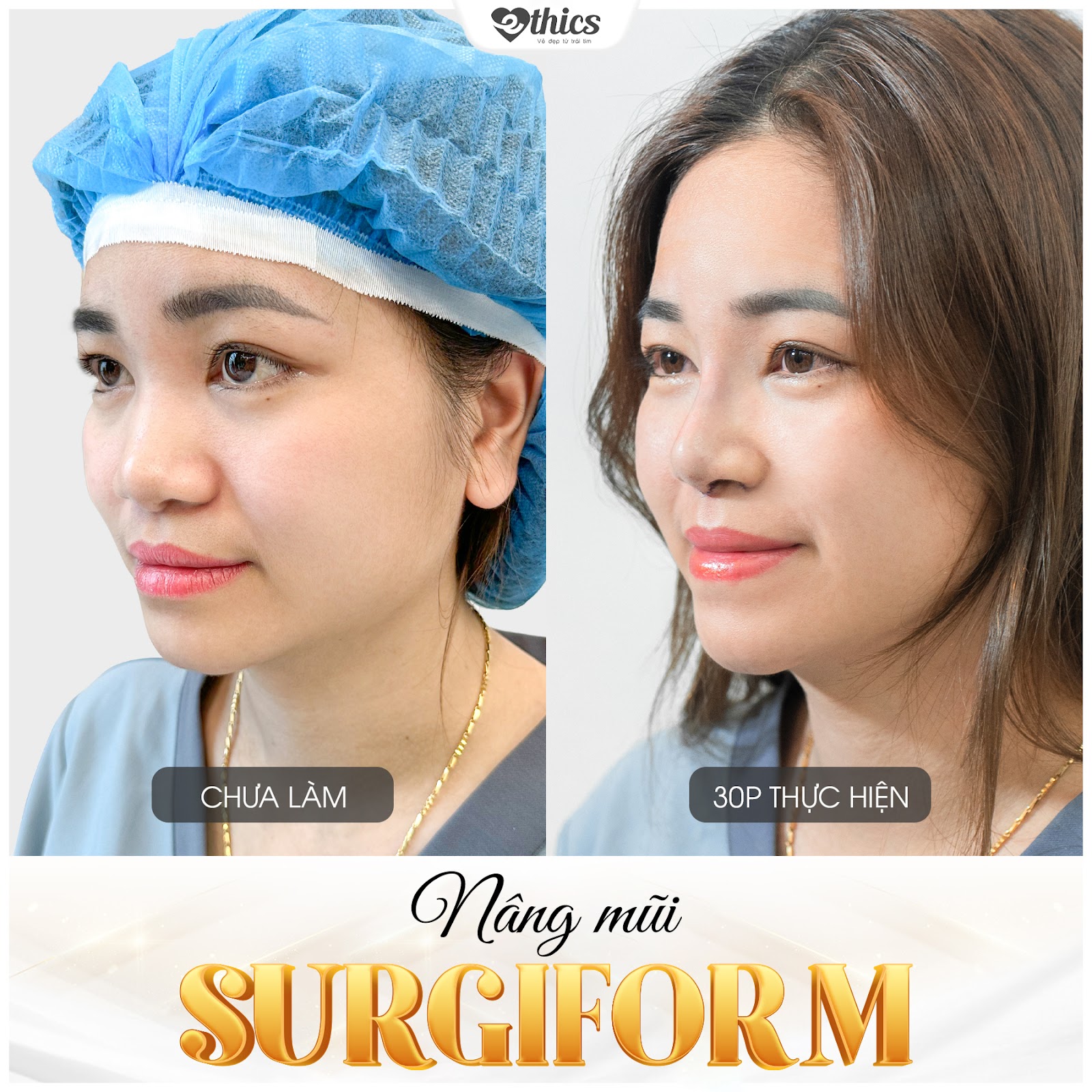 Nâng mũi Surgiform - Ưu Việt tạo sự khác biệt - 7