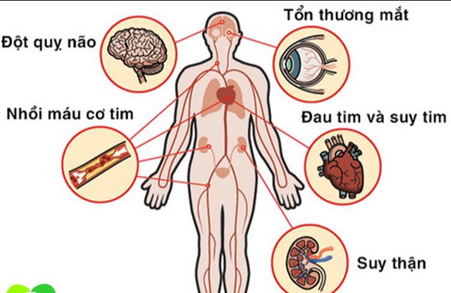 Các biến chứng có thể gặp khi huyết áp tăng cao. Ảnh minh họa