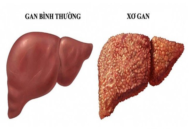 Thường xuyên uống rượu bia, những người này dễ bị bệnh xơ gan ‘ghé thăm’ - 2