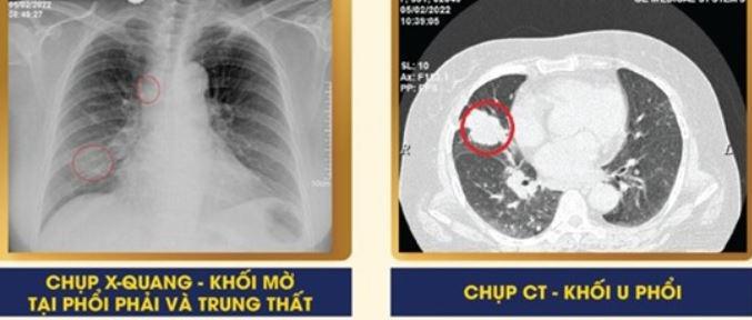 Vì sao chồng hút thuốc lá vợ lại mắc ung thư phổi, chuyên gia ung thư nói gì?- Ảnh 3.