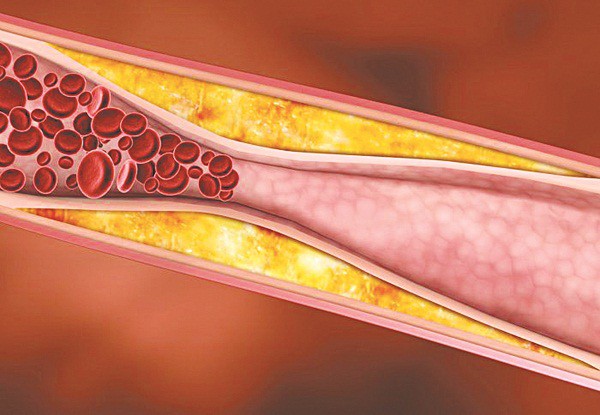 7 thay đổi đơn giản trong lối sống để giảm cholesterol, phòng bệnh mỡ máu - 1