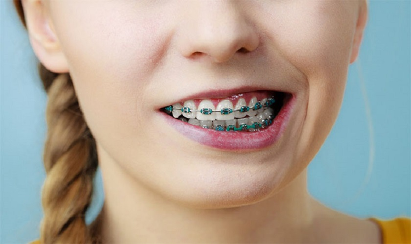 Niềng răng cải thiện sai lệch khớp cắn và mặt lệch như thế nào? - 1