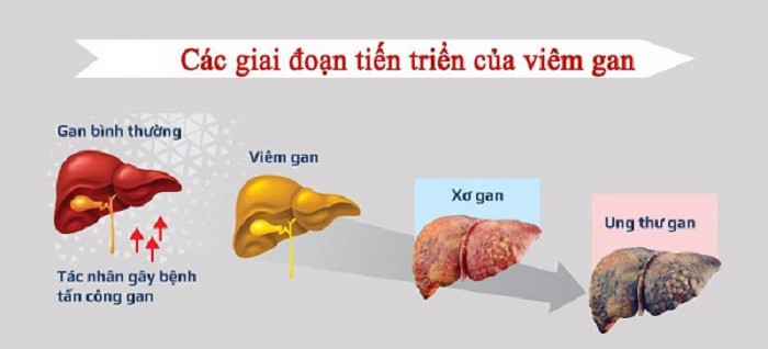 Uống rượu bia nhiều có nguy cơ mắc bệnh ung thư gì? - Ảnh 2.