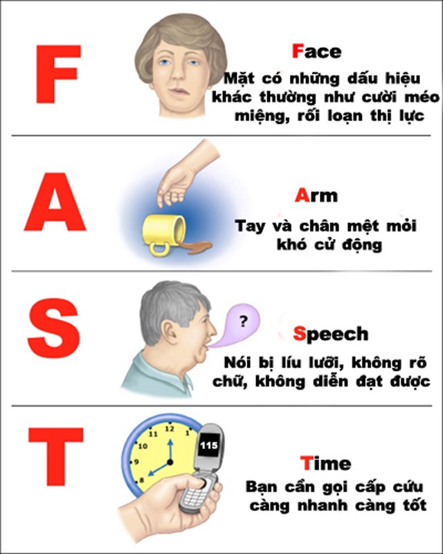 Quy tắc&nbsp;FAST đột quỵ giúp nhanh chóng nhận biết người có dấu hiệu đột quỵ để kịp thời cấp cứu, can thiệp.