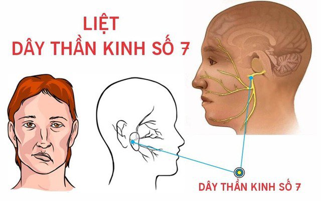 Hiện nay, liệt dây thần kinh số 7 ngoại biên là bệnh lý phổ biến đứng đầu trong số các bệnh của dây thần kinh mặt